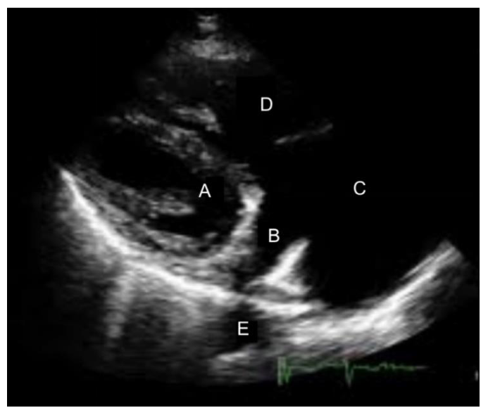 Figura da questão de Ecocardiografia