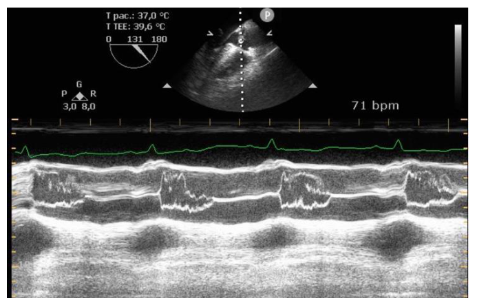 Figura da questão de Ecocardiografia