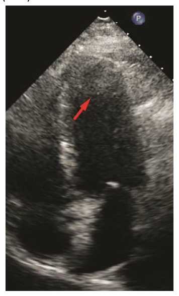 Figura da questão de Ecocardiografia